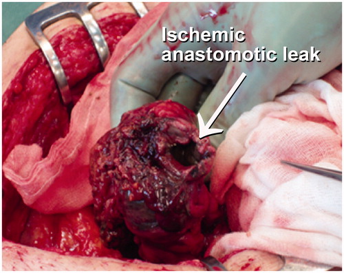 Figure 6. Ischemic anastomosis.