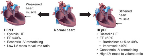 Figure 1. Key Differences Between HFpEF and HFrEF [Citation1,Citation10]. HF, heart failure; HFpEF, heart failure with preserved ejection fraction; HFrEF, heart failure with reduced ejection fraction; LV, left ventricle