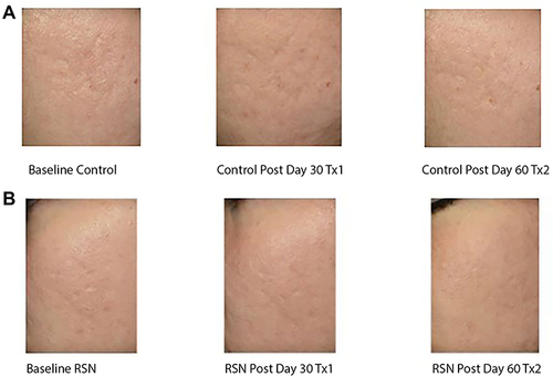 Figure 10 (A and B) 3D Micro Imaging monitoring skin texture difference in subject with bland moisturizer (A) and patient treated with RSN (B).