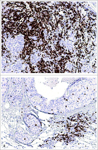 Figure 1. Immunohistochemical stainings of CD8+ T lymphocytes (brown) in breast cancer tissues representing (A) high and (B) low CD8+ TIL counts.