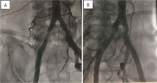 Figure 2. (a) Pre-stent angiogram showing 75% right common iliac artery occlusion; (b) post-stent angiogram associated with immediate relieve of back and leg pain.