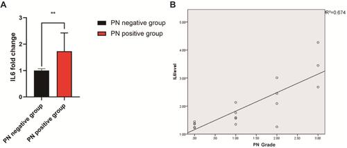 Figure 1 IL6 levels in multiple myeloma patients treated with bortezomib. (A) The expression level of IL6 was significantly higher in the PN-positive group than that in the PN-negative group. (B) The IL6 level was positively correlated with the BiPN grade (R2=0.674). **P<0.01.
