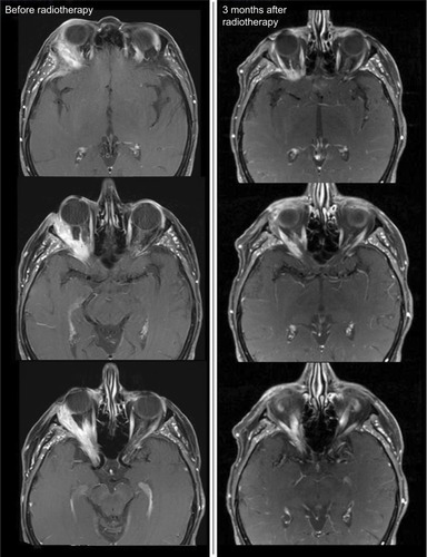 Figure 2 MRI before RT start in patient 20.Notes: In the initial MRI before RT start, you can see an ACC of the right lacrimal gland that infiltrates the right lateral medius muscle and shows perineural spread into the right cavernous sinus. Already at 3 months after primary bimodal RT, PR was diagnosed in the follow-up MRI.