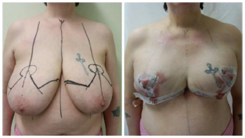 Figure 3 Breast reshaping.