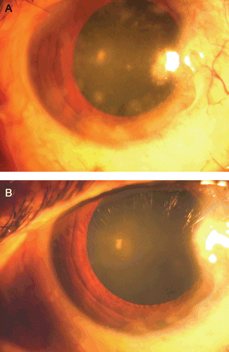 FIGURE 3  Slit-lamp photograph showing nummular lesions in the cornea with pigmented medium-sized keratic precipitates (A) and its disappearance following treatment with antivirals and topical steroids (B).