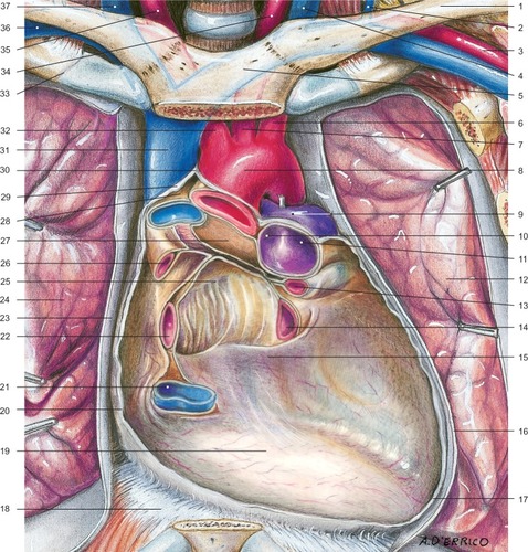 Figure 5 Aspect of the pericardium after resection and removal of its anterior wall, the great vessels, and heart.