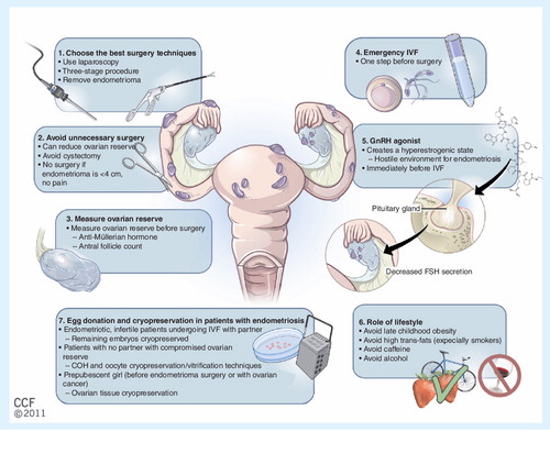 Figure 1. Seven ways to reduce infertility in patients with endometriosis.COH: Controlled ovarian hyperstimulation; FSH: Follicle-stimulating hormone; GnRH: Gonadotropin-releasing hormone.Reprinted with permission from the Cleveland Clinic Center for Medical Art & Photography © 2011–2012. All Rights Reserved.
