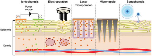 Figure 1. Physical techniques (a) iontophoresis: delivery of drugs containing ionizable groups, (b) electroporation: disruption of multilamellar lipid layer and permeabilization of skin followed by internalization of drug after treatment, (c) laser microporation: formation of micropores followed by passive diffusion from a patch to the deeper skin layers, (d) microneedle: insertion of drug coated microneedles into the skin, (e) sonophoresis, disruption of stratum corneum by microbubble assisted acoustic cavitation (skin layer thicknesses not drawn to scale).