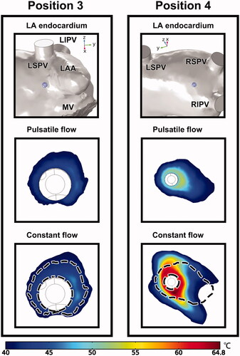 Figure 11. Temperature distribution of the endocardium at positions 3 and 4 under PP and CP, with the display of ablation site in LA. The dashed lines in the constant flow cases represent the outline of temperature distribution under PP. LAA: left atrial appendage; LSPV/LIPV/RSPV/RIPV: left superior/left inferior/right superior/right inferior pulmonary vein; MV: mitral valve.