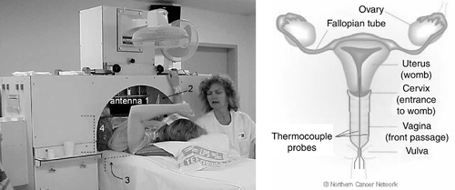 Figure 1. Left: Locoregional hyperthermia treatment of a cervical carcinoma patient with the 70 MHz AMC-4 phased array system; the location of the four antennas is indicated. Right: Schematic representation of the intratumoral and left and right vaginal thermocouple probes in the target region; the anatomical drawing was reprinted from The Northern Cancer Network website (www.cancernorth.nhs.uk).