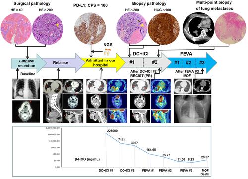 Figure 4 Clinical course. The patient underwent gingival resection, relapse, and was transferred to our hospital to receive 2 cycles of DC+ICI treatment, followed by 3 cycles of FEVA chemotherapy. Pathologic images revealed the biphasic growth pattern of cytotrophoblasts (yellow triangle) and syncytiotrophoblasts (yellow arrow). Dynamic observation of lesions imaging (red arrow) and β-HCG levels were shown below.