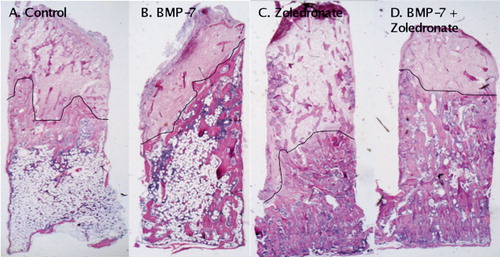 Figure 2. Histological specimens representing the 4 treatment groups after 6 weeks in the chamber (hematoxylin and eosin). Host tissue enters the graft through holes in the bottom of the chamber and ingrowth/remodeling occurs from the bottom upwards. The front of bone ingrowth is marked with a black line. A. Saline-treated chamber specimen with remodeled bone graft below the arrows. Most of the newly formed bone below the bone ingrowth front has already been remodeled into a fatty cell marrow. B. In the BMP-7-treated specimens, the bone ingrowth front has reached further into the graft than in the controls. C. In the zoledronate-treated specimens, the remodeled bone below the ingrowth front has a BV/TV (bone volume/total volume) value about 3 times higher than in the controls. D. Here, both BMP-7 and zoledronate were given and both the ingrowth distance and bone retention are increased compared to the control. The images have been chosen to be representative of the group median in terms of bone ingrowth and BV/TV value.