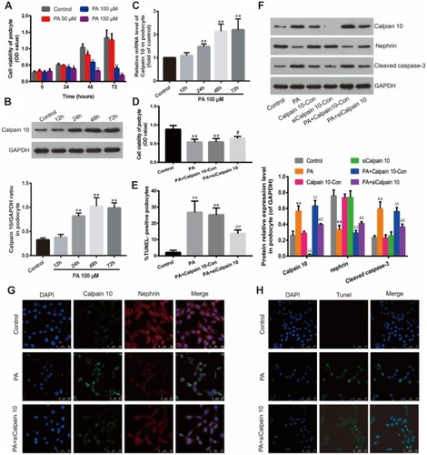 Figure 3 Down-regulation of Calpain 10 protected podocytes and reduced cell apoptosis under hyperlipidemic condition. (A) Effect of PA on podocyte viability. Podocytes were cultured with PA at different concentrations (50, 100, 150 μM) for various times (24, 48, 72 h). Relative cell viability was assessed with CCK-8. (B) Calpain 10 expression was identified by Western blot analysis. (C) Calpain 10 mRNA expression was tested by Real-time PCR. (D) Relative cell viability in podocytes treated as indicated was assessed with CCK-8. (E, H) Podocyte apoptosis in Control, PA, PA+siCalpain 10 was examined with Tunel-positive staining (original magnification×400). (F) Calpain 10, nephrin and caspase-3 expression in podocytes was identified by Western blot analysis. (G) Immunofluorescent for Calpain 10 and nephrin in podocytes treated as indicated (original magnification×630). Values are the mean ± SD; n=5,**P<0.01 compared with the control group; ΔΔP<0.01 compared with the Calpain10-Con group; #P<0.05,##P<0.01 compared with the PA+Calpian10-Con group.