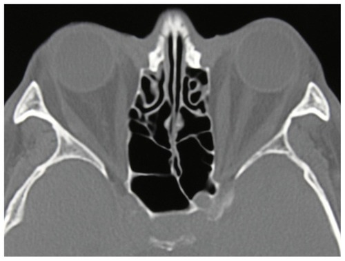 Figure 3B Axial computed tomography demonstrates bilateral medial and lateral recti muscle enlargement.