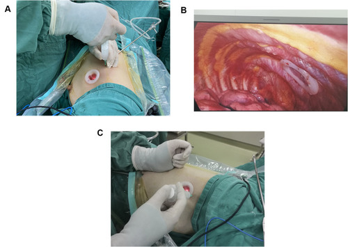 Figure 2 (A–C) TINB were administered by infiltration of local anesthetic mixture (15 mL for each intercostal space) from the third to the ninth intercostal nerve under the parietal pleura, 2 cm lateral to the sympathetic chain, using an infusion needle.