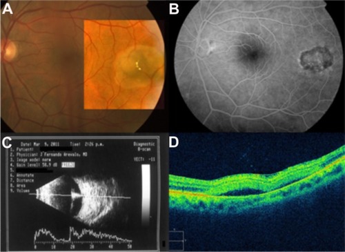 Figure 56 (A) Color fundus photograph, (B) fluorescein angiogram, (C) B-scan ultrasound, and (D) Cirrus™ optical coherence tomography image demonstrate commotio retinae and an intraocular foreign body.