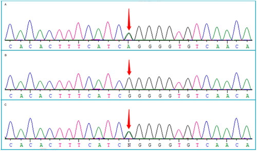 Figure 4. Patient with a heterozygous mutation c.31G > A (p.G11R) in the GJB6 gene (A); his father is wild-type (B); his mother carries a heterozygous mutation c.31G > A (p.G11R) in the GJB6 gene (C).