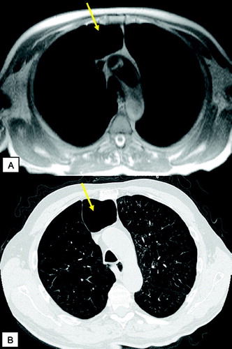 Figure 3 Axial T2 weighted MR (HASTE) image (A) and corresponding HRCT (B) showing severe panlobular emphysema and a large bulla (arrow). The rarefication of the pulmonary arteries and reduction of parenchyma are reflected by a general signal loss on MRI.