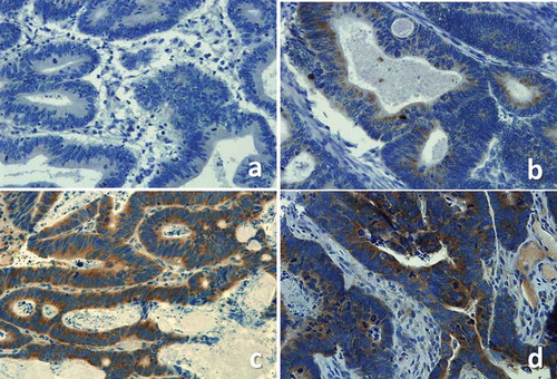 Figure 1. Examples of VEGF negative (a), weak (b), moderate (c) and strong (d) staining.