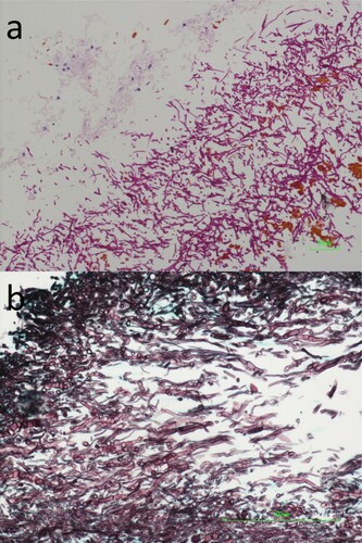 Figure 2. Photomicrographs of the biopsied liver abscess wall tissue. (a) Abundant fungal hyphae, a small amount of necrotic tissue, brown bile pigments as well as a few acute inflammatory cells were observed (Periodic acid-Schiff staining, original magnification 200×). (b) The fungal hyphae were highly septate (Grocott methenamine-silver staining, original magnification 400×).