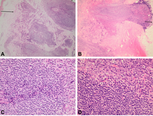 Figure 2 (A) A dense dermal infiltrate that shows a follicular growth pattern sparing the epidermis and separated by a Grenz zone (arrow) (H&E, 4x). (B) The infiltrate focally extends to the subcutaneous fat (arrow) (H&E, 4x). (C and D) A predominance of small cells with irregular, elongated or angulated nuclei with inconspicuous nucleoli. Larger cells with more rounded nuclei, open chromatin, and peripheral nucleoli are demonstrated (H&E, 40x).