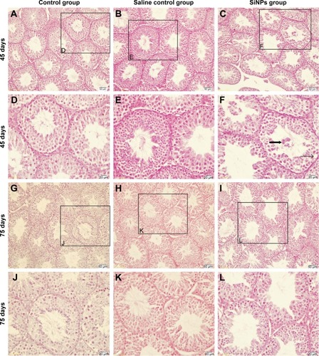 Figure 2 The effects of SiNPs on the structure of testicular tissue in mice.Notes: (A and D) The shape of seminiferous tubles and the cell arrangement were regular in the control group on the 45th day after the first dose. (B and E) The shape of seminiferous tubles and the cell arrangement were regular in the saline control group on the 45th day after the first dose. (C and F) The shape of seminiferous tubles and the cell arrangement were irregular after exposure to SiNPs for 45 days. SiNPs led to vacuolization and exfoliated cells in some seminiferous tubles. (G and J) The shape of seminiferous tubles and the cell arrangement were regular in the control group on the 75th day after the first dose. (H and K) The shape of seminiferous tubles and the cell arrangement were regular in the saline control group on the 75th day after the first dose. (I and L) The shape of seminiferous tubles and the cell arrangement were regular in the SiNPs group on the 75th day after the first dose, and the vacuolization and exfoliated cells in some seminiferous tubles induced by SiNPs weren’t observed. The figure shows optical microscope images of testis. The thin black arrow represents the vacuolization, and the wide black arrow represents the exfoliated cells. The data indicated that SiNPs could damage the seminiferous epithelium in testis of mice.Abbreviation: SiNPs, silica nanoparticles.