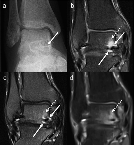 Figure 6 Metal artifact reduced 1.5T MRI of the ankle. Patient with previous screw fixation for fracture. (a) Anteroposterior radiography; arrow: screw. (b) Coronal intermediate weighted turbo spin-echo sequence with fat saturation. Hyperintense susceptibility artifacts adjacent to the screw (arrows) obscure BME (dotted arrow). (c) MARS STIR sequence view-angle-tilting. Differentiation between BME (dotted arrow) and artifact (arrows) is challenging. (d) CSSEMAC STIR sequence susceptibility artifacts are entirely eliminated. True BME is revealed (dotted arrow). Image resolution and quality however are reduced. Therefore, application of SEMAC should only be considered if the structures to be evaluated are in close proximity to large metal implants.