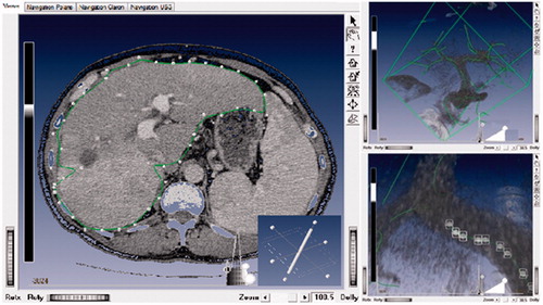 Figure 1. Manual improvement of the liver surface segmentation result by moving the control point (left); selection of the right wall of the cube allows movement to curve in the corresponding spatial direction (bottom left corner in the same picture); the liver vessel model represented as a set of central lines (right-up); control points for the selected curve for manual correction of the spatial position (right-down).