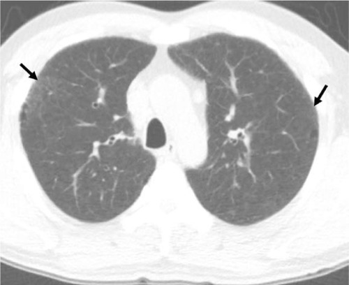 Figure 1 A 45-year-old male smoker with pathologically diagnosed RB.