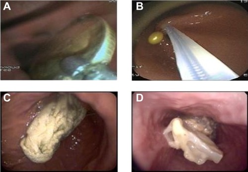 Figure 1 Examples of foreign bodies.