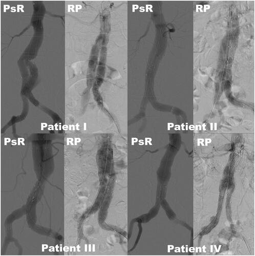 Figure 4. Comparing angiograms after stent graft deployment of four patients (I-IV) from the simulator (PsR) and from the real procedure (RP). Patient I, age 59, poor correlation; Patient II, age 82, good correlation; Patient III, age 63, poor correlation; Patient IV, age 80, good correlation. Stitching artefacts can be seen at the aortic neck of patient III and IV on the simulated pictures.