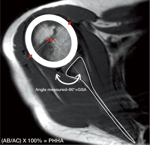 Figure 2. Schematic image showing the measurement of glenoscapular angle (GSA) and the percentage of humeral head anterior to the middle of the glenoid fossa (PHHA): i.e. (AB/AC) × 100%.
