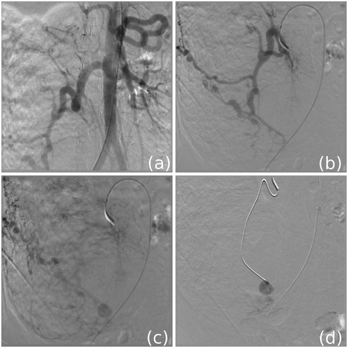Figure 3. Pre-procedure renal angiogram (a), selective tumor arterial angiogram (b) and demonstration of pseudoaneurysm (c), with placement of tip of microcatheter at pseudoaneurysm (d).