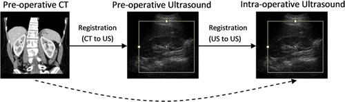 Figure 1. Methodology for registering pre-operative CT to intra-operative ultrasound.