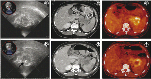 Figure 3. (a, b) Gray-scale changes of HIFU obtained on real-time ultrasound (US) images during HIFU procedure. (a) US image obtained before HIFU shows a large pancreatic carcinoma lesion present in tail of pancreas. (b) US images obtained immediately after HIFU procedure show the hyperechogenicity (arrows) of treated tumour in the one slice lesion. (c) A CT scan made before HIFU demonstrates a tumour in the tail of the pancreas. (d) A CT scan demonstrates no significant size change one month after HIFU treatment. (e) A PET-CT scan made before HIFU demonstrates a SUVmax of 7.5g/mL. (f) The PET-CT scan made 3 months after HIFU demonstrates coagulative necrosis inside the tumour and the decreasing of the SUVmax value to 5.3 g/mL. All images are taken from the same patient.