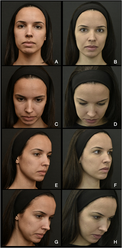 Figure 7 26-yr-old female submitted to Step 2: reinforcement of SMAS with MFU-V in the mid and lower thirds with 7MHz - 3.0mm transducer (190 lines) and 4MHz - 4.5mm transducer (120 lines), based on the see-plan treatment. Step 3: Injection of deep malar fat pads for fat pad repositioning (1mL/side of HAV using a 25-G cannula in fanning technique). In pre-treatment images (A, C, E, G) sagging of the medial and inferior third of the face is visible, as a consequence of the skin laxity and a reduction of the deep medial cheek fat compartment. In the post-treatment images (B, D, F, H) a reduction of the skin laxity and sagging can be observed as a consequence of the skin tightening achieved after the MFU-V treatment and replacement of the volume by the injection of HA in the anterior malar area.