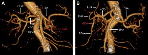 Figure 3 Right hepatic artery deriving from GDA.