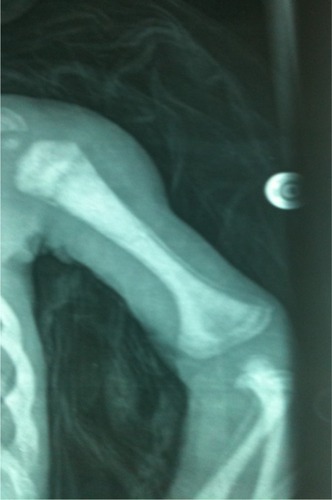 Figure 5 Medullary stenosis with osteoscelosis in a patient with Sanjad–Sakati syndrome.