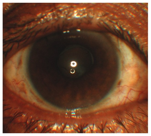 Figure 2 Anterior segment photograph showing a clear visual axis after laser anterior capsulotomy.