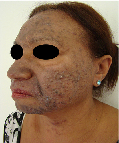 Figure 2 Clinical case of acne menopausal adult woman - 54-year-old normoandrogenic patient with moderate to severe acne on the face and neck associated with dyschromia.