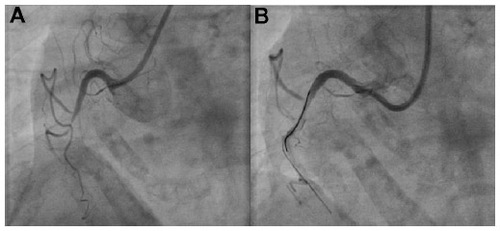 Figure 12 Poor support provided by a Judkins right changed to an Amplatz I with buddy wire support percutaneous coronary intervention to a total occlusion of the mid right coronary artery.