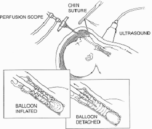 Figure 4. Tracheal occlusion with balloon. (Reprinted with permission; Artist - S. Quan.)