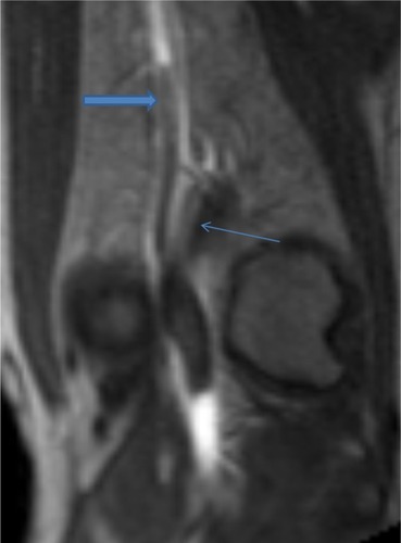 Figure 1 Fast low-angle shot 3D coronal T1-weighted post-contrast magnetic resonance image of the left knee demonstrates occlusion of the above-knee popliteal artery (thick arrow) as well as a lateral aberrant insertion of the medial head of the gastrocnemius muscle onto the distal femur (thin arrow).