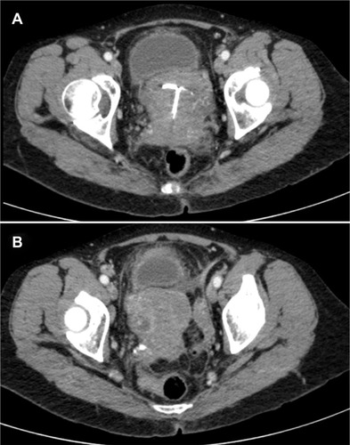 Figure 6 Abdominal computed tomography scan showing peritoneal effusion and heterogeneous pelvic mass surrounding an intrauterine device (A), with abscesses (B) corresponding with pelvic actinomycosis.
