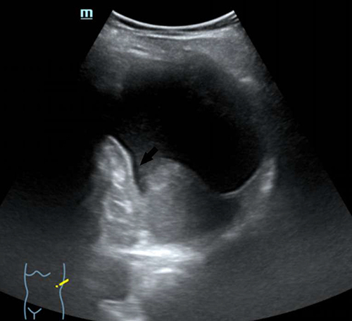 Figure 4 An oblique left quadrant B-mode abdominal sonography three months after the initial CT scan showed an inferiorly displaced spleen with a 7.3 cm x 7.2 cm left subdiaphragmatic cystic lesion that showed an increased posterior through transmission and a beak-like linear extension to the splenic hilum region (black arrow). The pancreas, as well as the lesser sac space, were free of cystic areas. The splenic cystic lesions were also resolved.