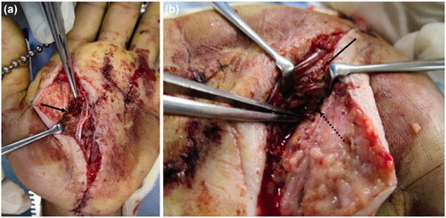 Figure 5. (a) Clay-like adherent paint is observed in the thenar space (arrow). (b) After removing paint, the inside of the carpal tunnel was checked, and paint is observed between the flexor tendons (solid arrow: palmer aponeurosis, dashed arrow: paint).