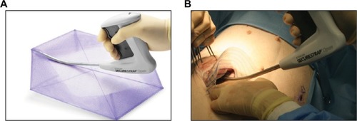 Figure 1 (A) Illustration of the use of Ethicon Securestrap® Open Absorbable Strap Fixation Device to secure Ethicon Physiomesh™ Open Flexible Composite Mesh for an IPOM hernia repair and (B) intraoperative image obtained during fixation of Ethicon Physiomesh Open Flexible Composite Mesh using the Ethicon Securestrap Open Absorbable Strap Fixation Device in a porcine simulated ventral hernia model.