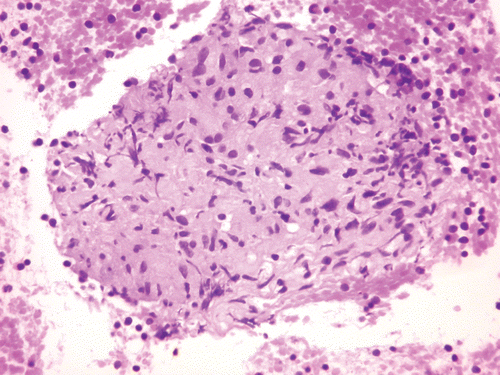 FIGURE 2  Non-caseating granuloma mainly composed of epithelioid cells with scattered lymphocytes in ultrasound-guided transbronchial biopsy of mediastinal adenopathy (Cell block; Hematoxylin and eosin stain; X400).