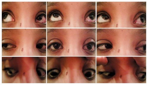 Figure 5 Postoperative pictures of Case 8 (1 month after surgery) with less lid edema and improved up-gaze of left eye.