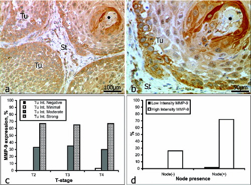 Figure 3. Immunoreactivity for MMP-9 (a and b): keratinized pearl (asterisk); St = stroma; Tu = tumour. Correlation between MMP-9 expression intensity and tumour stage (c); lymph-node involvement (d).